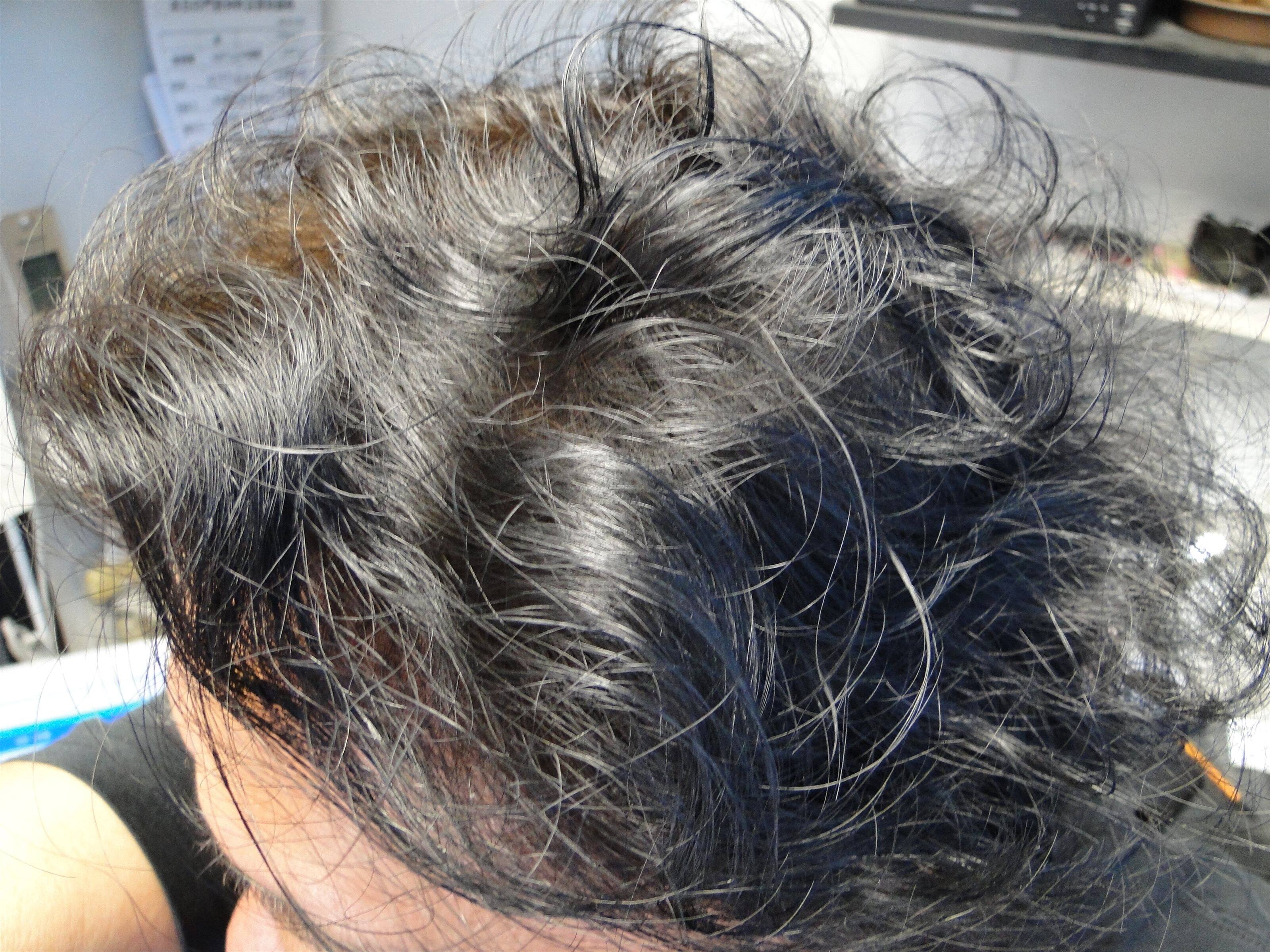 管理人シバの薄毛成功